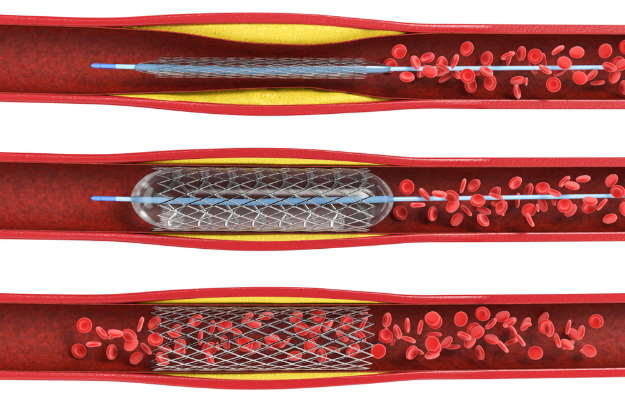 How Stents Work Key Uses Benefits And Potential Side Effects