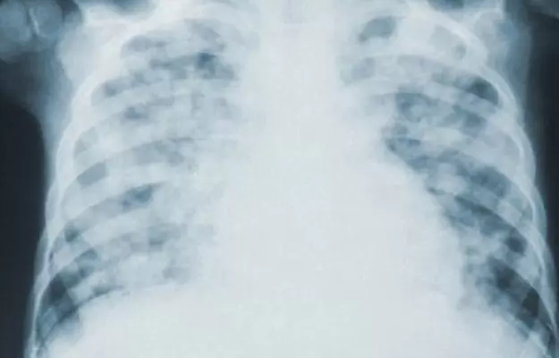 Pneumonia and COVID-19