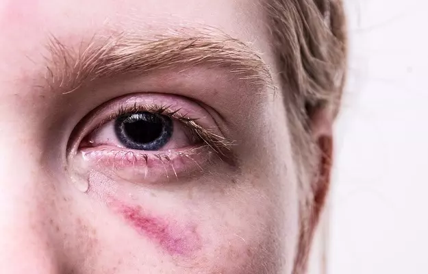 क्या आंखों को भी प्रभावित करता है कोविड-19 इंफेक्शन?