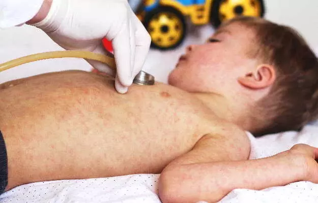 कोविड-19 महामारी के चलते करीब 12 करोड़ बच्चे खसरे की वैक्सीन से रह सकते हैं वंचित: संयुक्त राष्ट्र