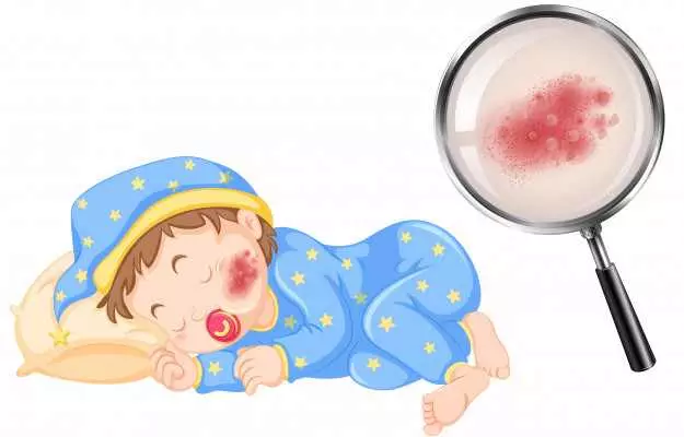 नवजात शिशु को एक्जिमा - Eczema in newborn baby in Hindi