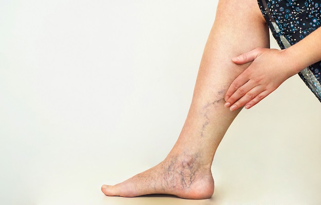 6 ways to avoid varicose veins from pregnancy. Yes, they do include support  hose.