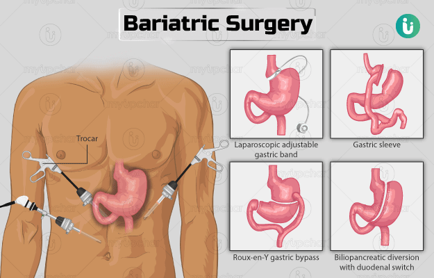 बैरिएट्रिक सर्जरी - Bariatric surgery