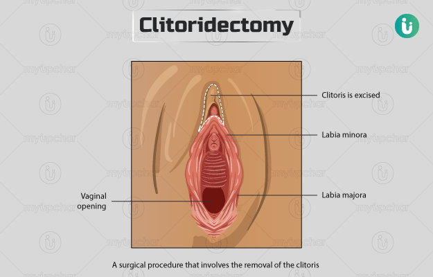 क्लिटोरीडेक्टमी - Clitoridectomy