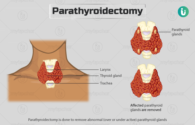 पैराथायराइडेक्टॉमी - Parathyroidectomy in Hindi