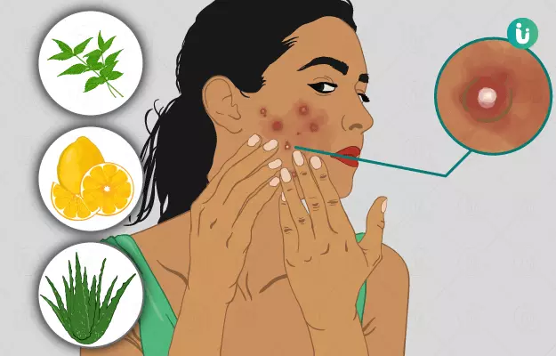 How to get rid of acne or pimples