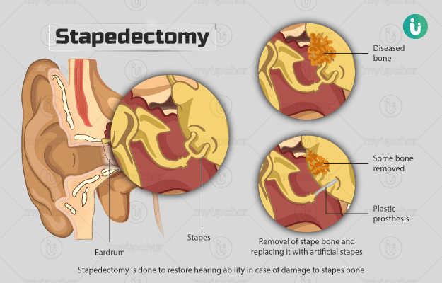 स्टेप्डेक्टोमी - Stapedectomy