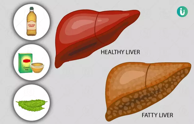 Home Remedies for Fatty Liver