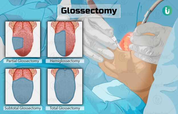 ग्लोसेक्टोमी - Glossectomy in Hindi