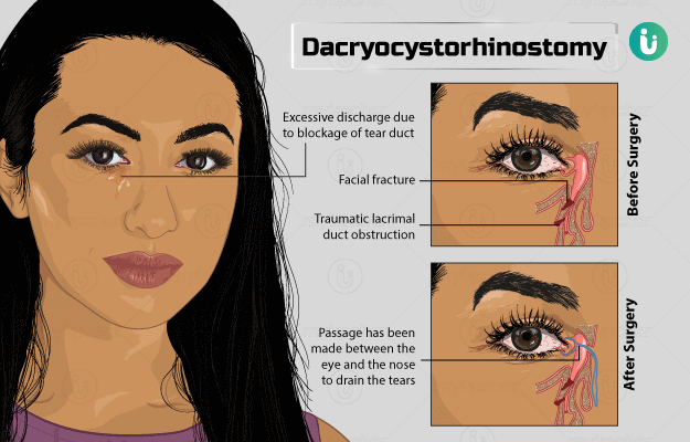 डेक्रायोसिस्टोराइनोस्टमी - Dacryocystorhinostomy