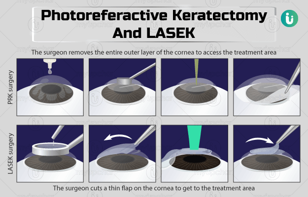 Photoreferactive keratectomy LASEK: Procedure, Results, Cost, Price