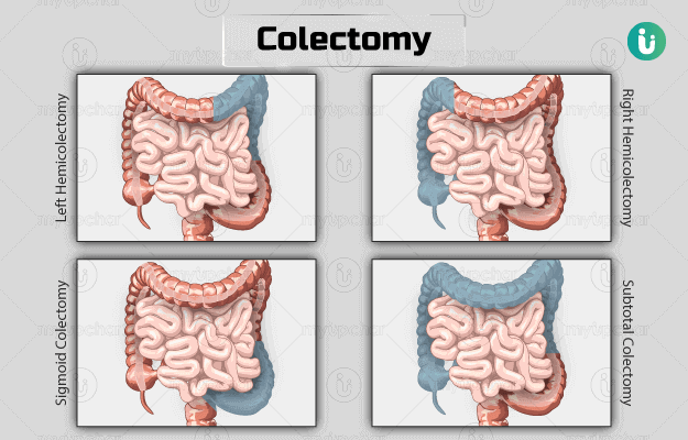 Colectomy Surgery Procedure