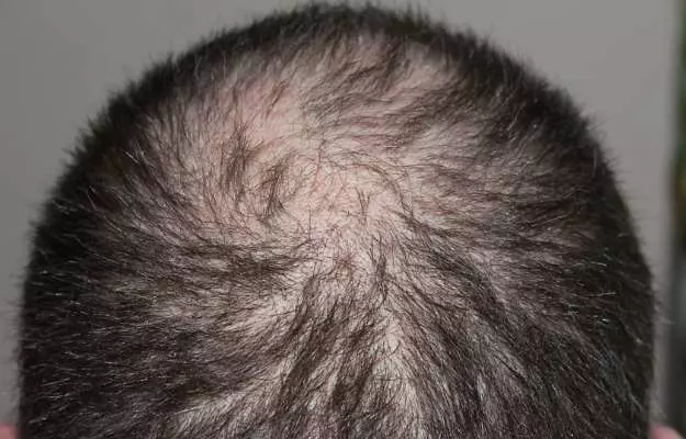 జుట్టు రాలడం యొక్క కారణాలు - Hair Loss Causes in Telugu