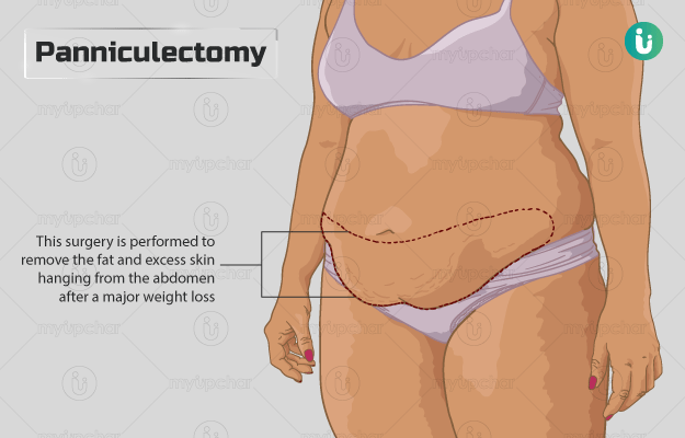 Panniculectomy Surgery: Procedure and Recovery