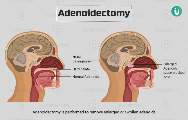 एडिनॉइडेक्टमी - Adenoidectomy in hindi