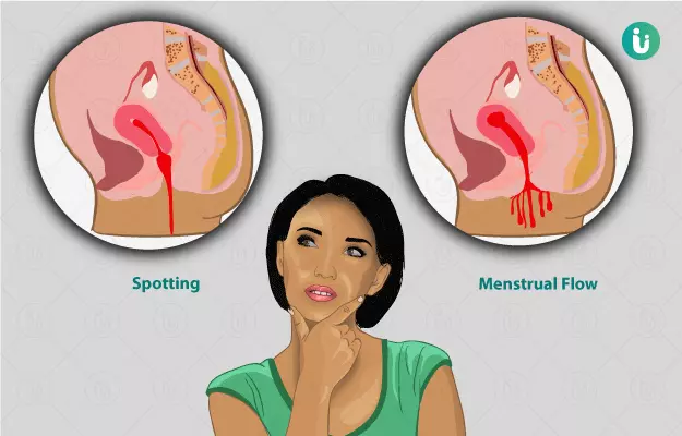 Vaginal bleeding causes and treatment