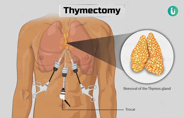 थाइमेक्टोमी - Thymectomy in Hindi