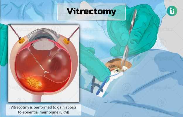 विटरेक्टोमी - vitrectomy in hindi