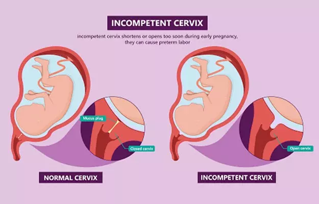 कमजोर ग्रीवा में टांके लगाना (सर्वाइकल सरक्लाज़) - Cervical cerclage in hindi
