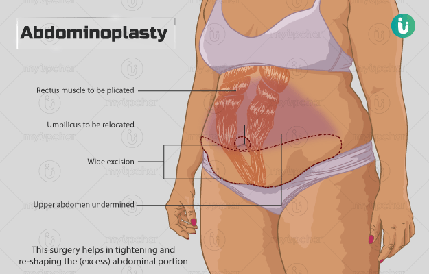 एब्डोमिनोप्लास्टी - Abdominoplasty surgery in Hindi