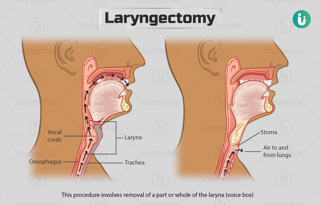 लैरिनगेक्टोमी - Laryngectomy in Hindi