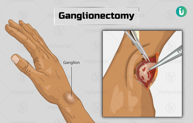 गैंग्लियोनेक्टोमी - Ganglionectomy in Hindi
