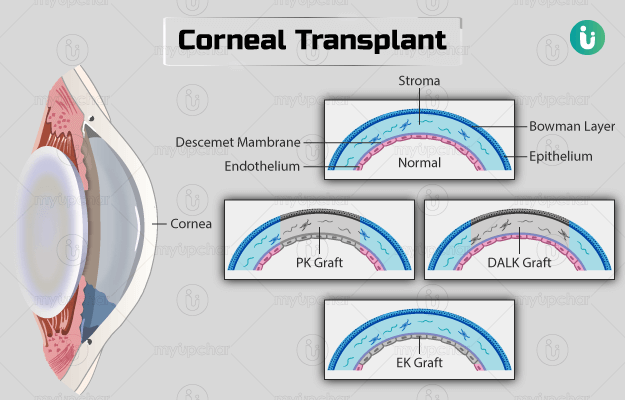 कॉर्नियल ट्रांसप्लांट - Corneal transplant in Hindi