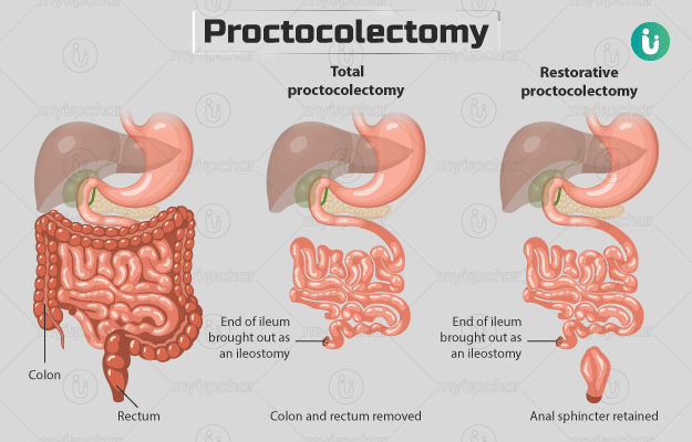 Proctocolectomy