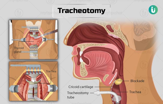 tracheostomy procedure anatomy