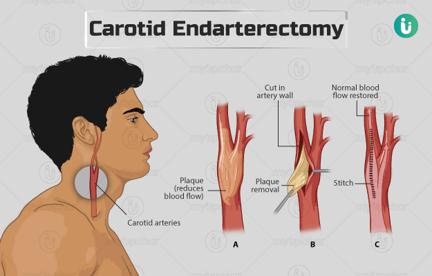 कैरोटिड एंडरटेरेक्टॉमी - Carotid endarterectomy in Hindi