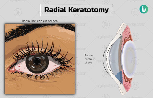 रेडियल केराटोटॉमी - Radial keratotomy in hindi