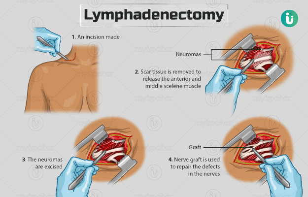 लिम्फेडेनेक्टोमी - Lymphadenectomy