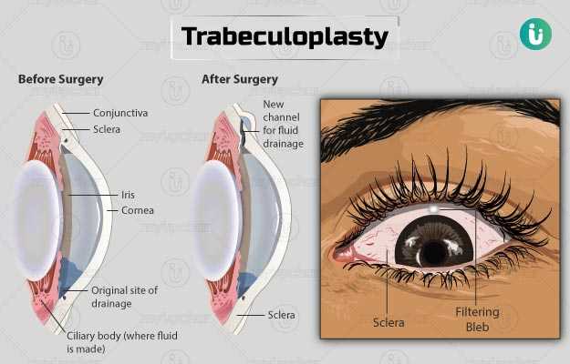 ट्रेबक्युलोप्लास्टी - Trabeculoplasty