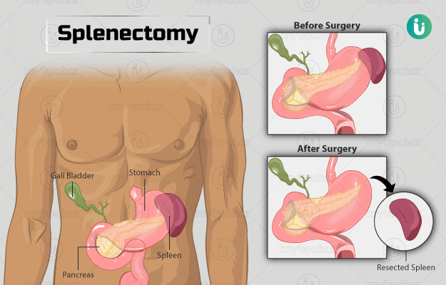 प्लीहा निकालने की सर्जरी (स्पलेनेक्टॉमी) - Splenectomy