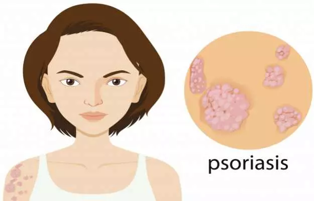 Siddha treatment for psoriasis