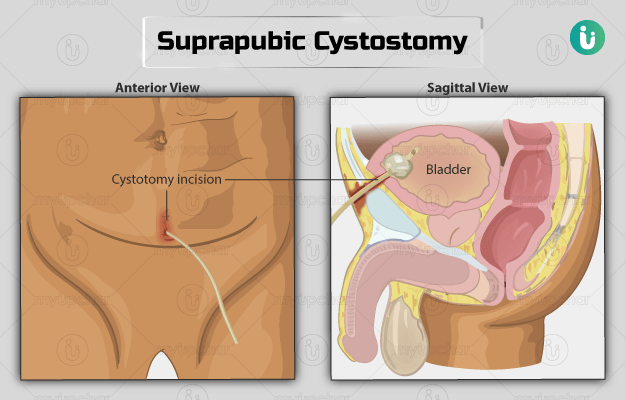 सुप्राप्युबिक सिस्टोस्टोमी - Suprapubic cystostomy in Hindi
