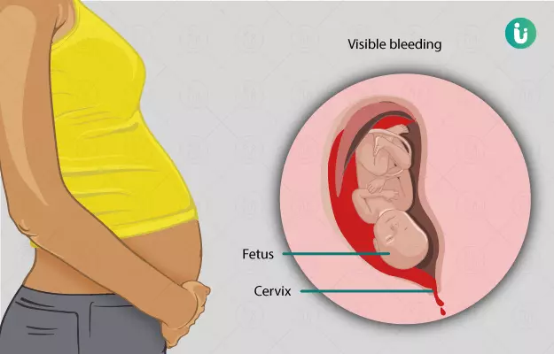 गर्भावस्था में रक्तस्राव - Bleeding During Pregnancy in Hindi