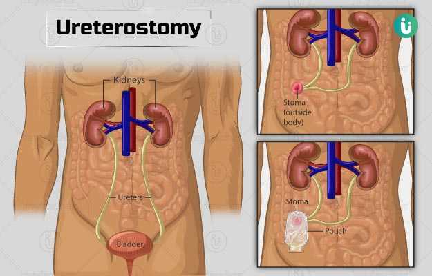 यूरेटेरोस्टोमी - Ureterostomy in Hindi