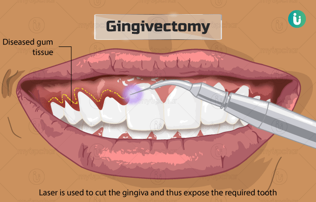 जिंजीवेक्टमी - Gingivectomy in hindi