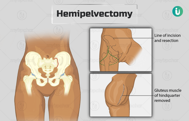 हेमीपेल्वेक्टोमी - Hemipelvectomy in Hindi