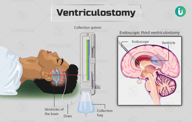 वेंट्रिक्युलोस्टोमी - Ventriculostomy in hindi