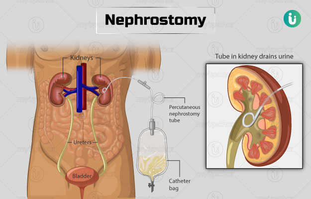 नेफ्रोस्टोमी - Nephrostomy in Hindi