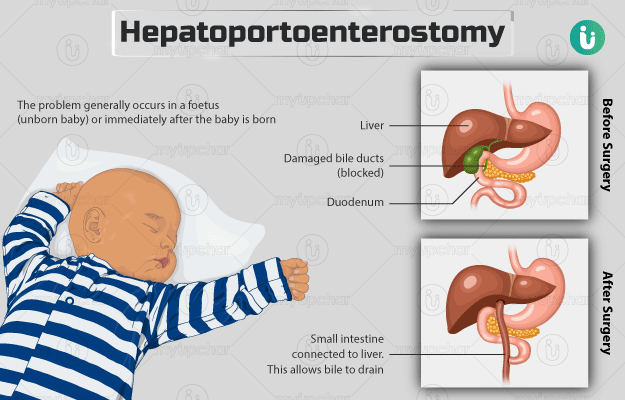 केसाई प्रोसीजर - Kasai Procedure (Hepatoportoenterostomy) in Hindi