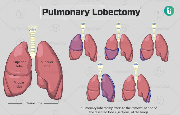 Pulmonary lobectomy