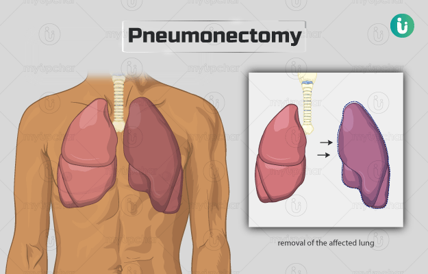न्यूमोनेक्टॉमी - Pneumonectomy in Hindi