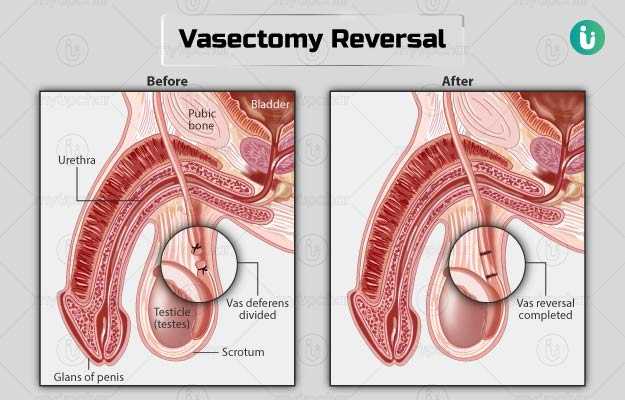 वासेक्टोमी रिवर्सल - Vasectomy reversal in Hindi