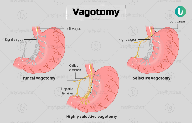 वेगोटोमी - Vagotomy in Hindi