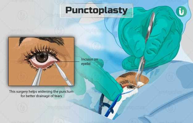 Punctoplasty