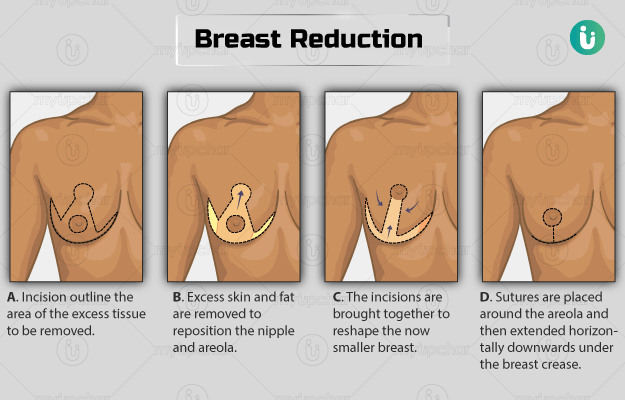 Breast reduction surgery (female)/Gynecomastia surgery (male): Procedure,  Purpose, Results, Cost, Price
