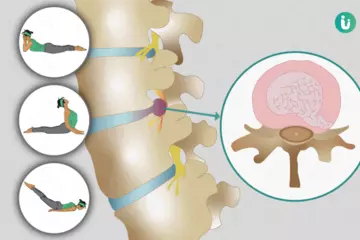 Managing Slip Disc Pain: Yoga Poses for a Stronger Back